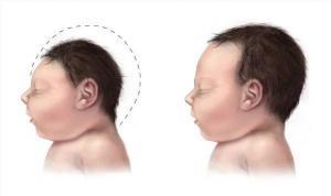 Zika image